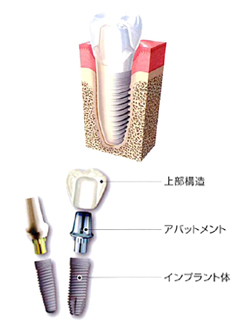 インプラント治療とは