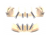 All-on-4によるインプラントの配置	