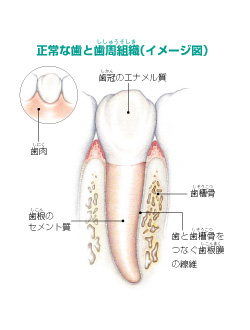 歯周病とは