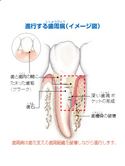 歯周病とは